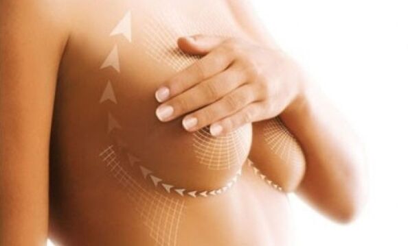 Levantamento de sutura para o aumento da mama