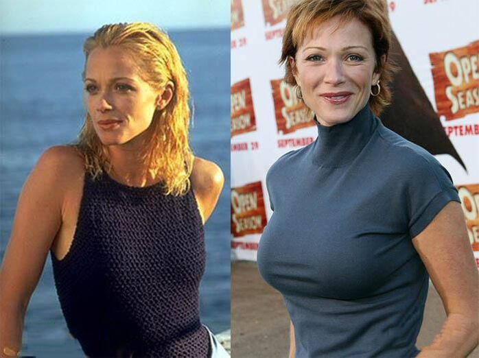 Antes e despois da mamoplastia
