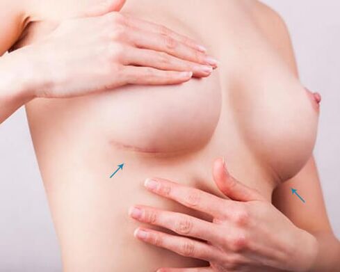Aumento de mama con implantes