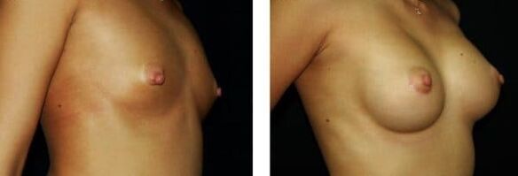 antes e despois do aumento de mama